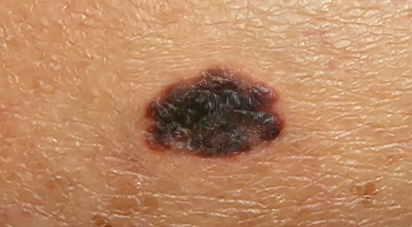 melanoma