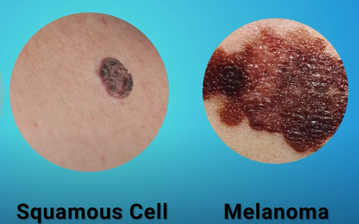 melanoma vs squamous cell