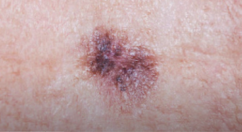 squamous cell carcinoma