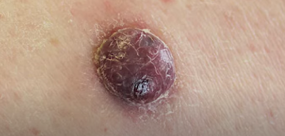 squamous cell carcinoma